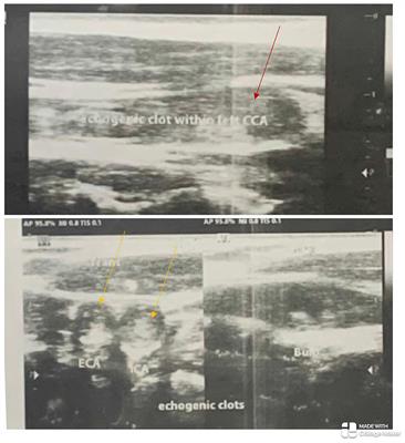 Case report: A rare case of catastrophic Takayasu arteritis: acute ischemic stroke and anterior ischemic optic neuropathy